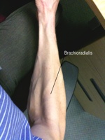 2009-09-11--Brachioradialis