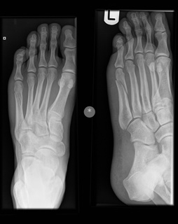 Fracture 5th metatarsal