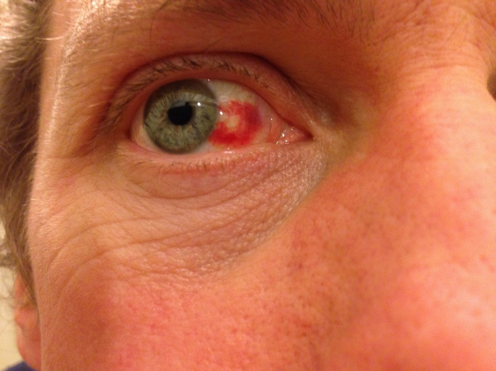 Sub-conjuntival haematoma at 48 hours