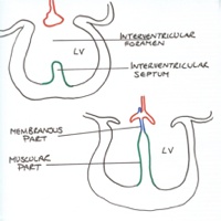 Dividing the ventricle