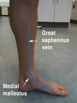 Great Saphenous Vein