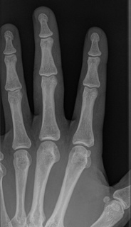 Hand X-Ray Part
